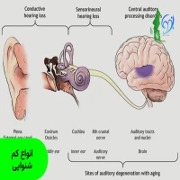 انواع کم شنوایی 2